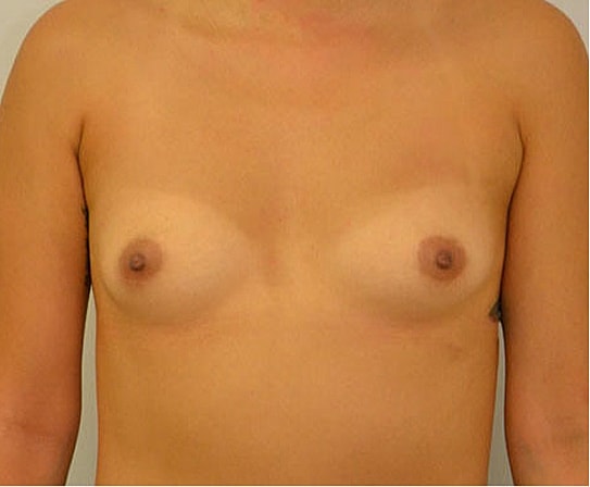 Breast Augmentation Before & After