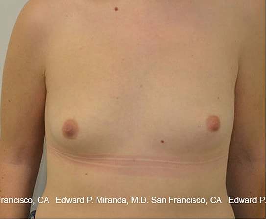 Breast Augmentation Before & After