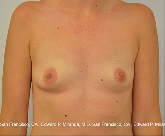 Breast Augmentation Before & After