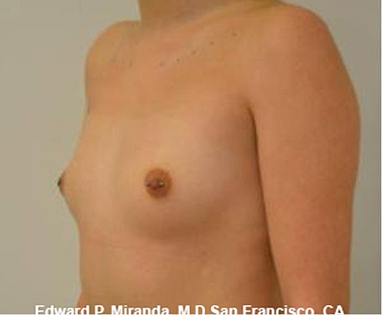 Breast Augmentation Before & After