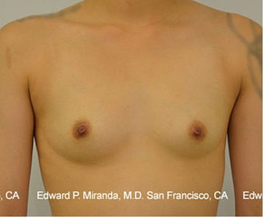 Breast Augmentation Before & After