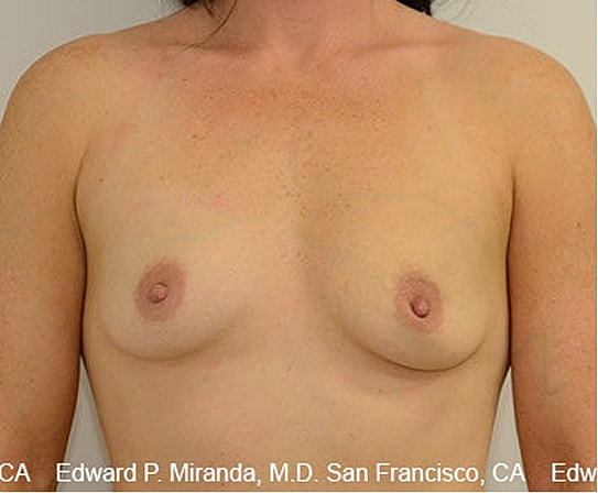 Breast Augmentation Before & After