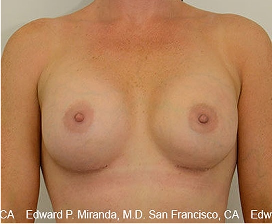 Breast Augmentation Before & After