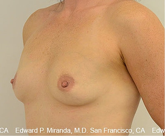 Breast Augmentation Before & After
