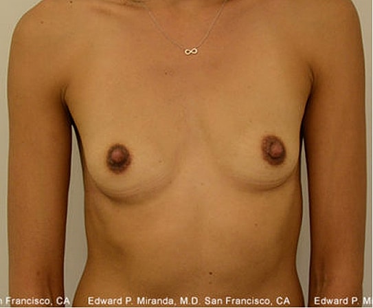 Breast Augmentation Before & After
