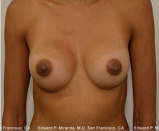 Breast Augmentation Before & After