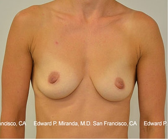 Breast Augmentation Before & After