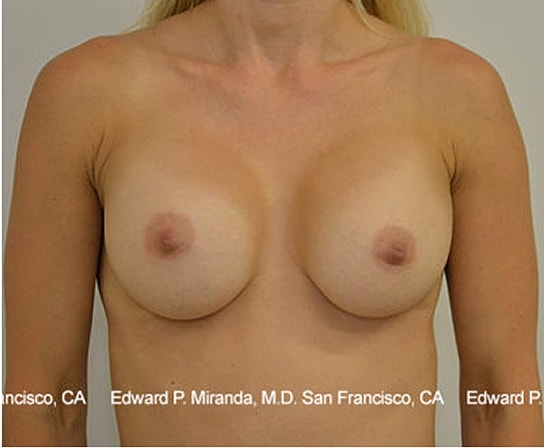 Breast Augmentation Before & After