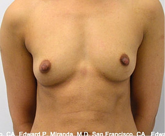 Breast Augmentation Before & After