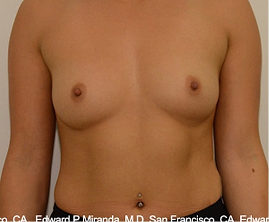 Breast Augmentation Before & After
