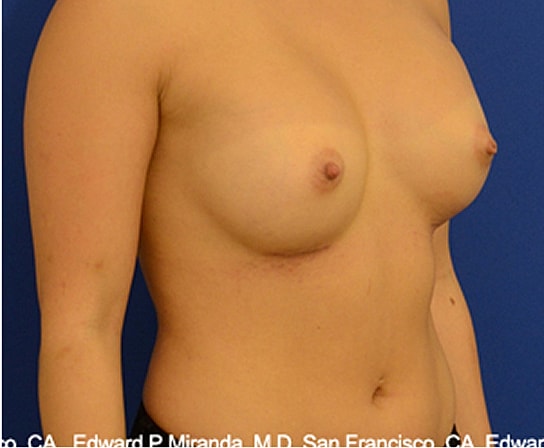 Breast Augmentation Before & After
