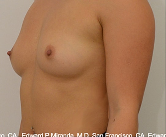 Breast Augmentation Before & After