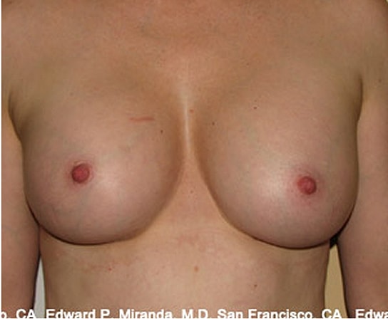 Breast Augmentation Before & After