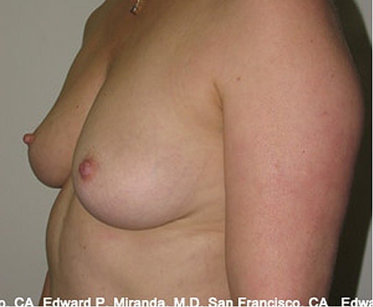 Breast Augmentation Before & After