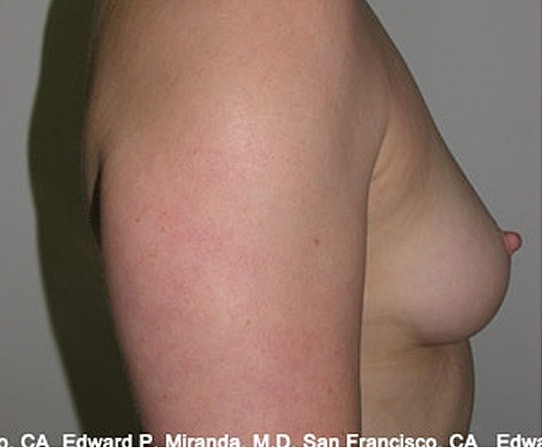 Breast Augmentation Before & After