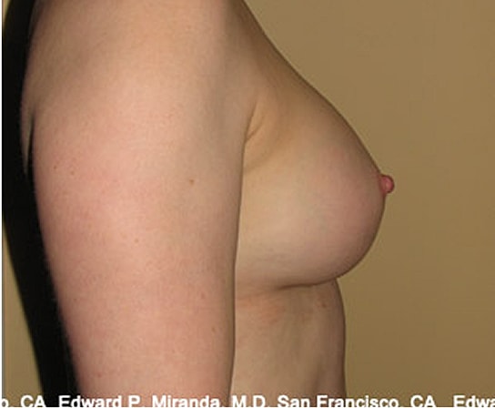 Breast Augmentation Before & After