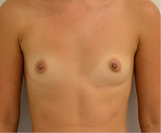 Breast Augmentation Before & After