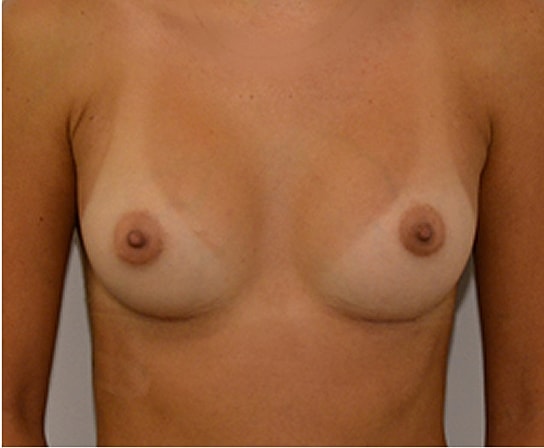 Breast Augmentation Before & After