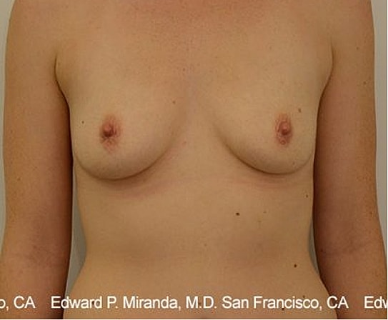 Breast Augmentation Before & After