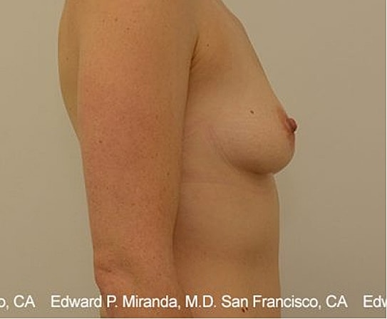 Breast Augmentation Before & After