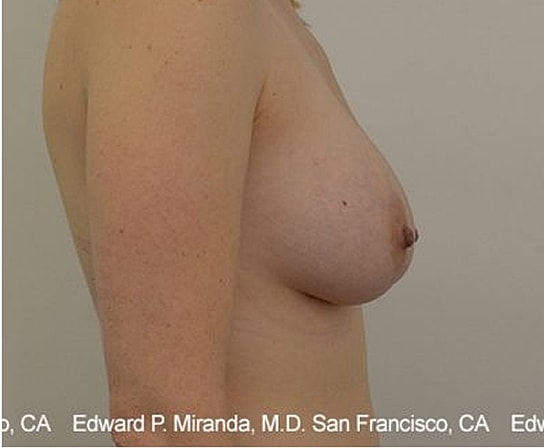 Breast Augmentation Before & After