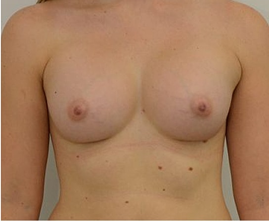 Breast Augmentation Before & After