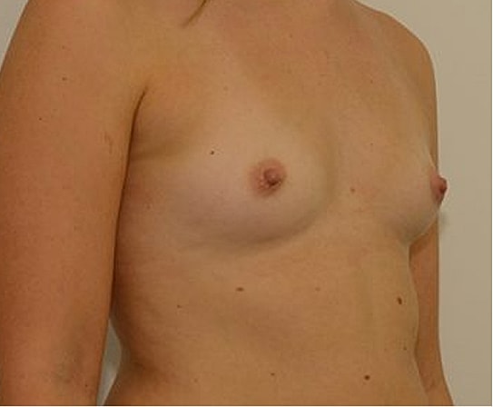 Breast Augmentation Before & After