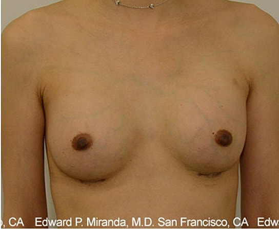 Breast Augmentation Before & After