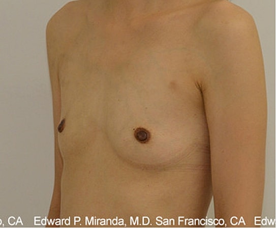Breast Augmentation Before & After