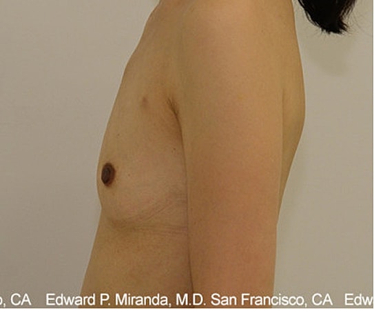 Breast Augmentation Before & After