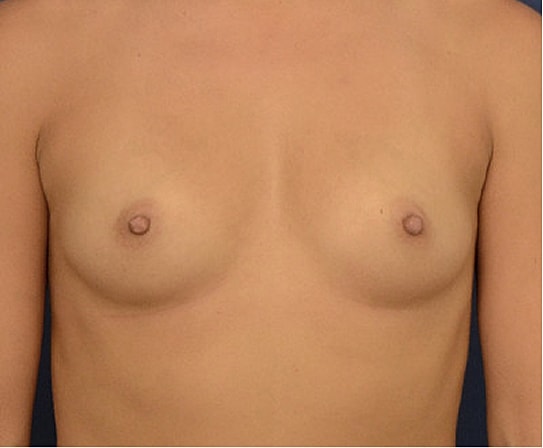 Breast Augmentation Before & After