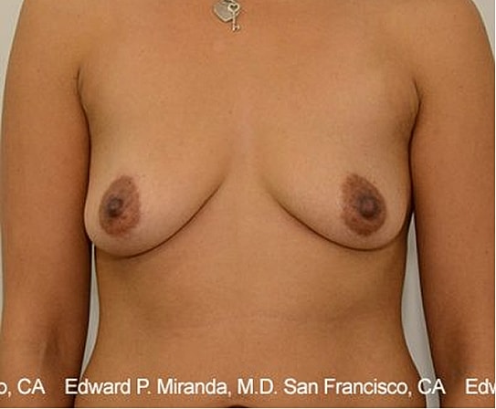 Breast Augmentation Before & After