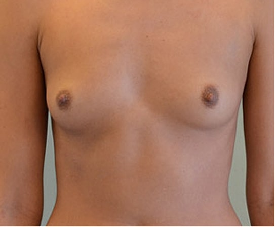 Breast Augmentation Before & After