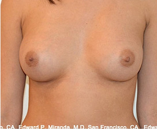 Breast Augmentation Before & After