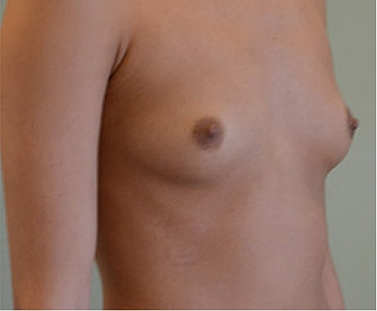 Breast Augmentation Before & After