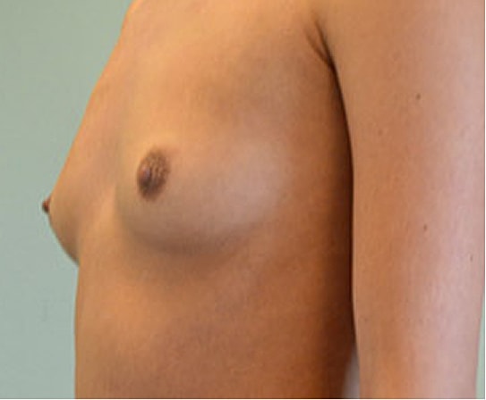 Breast Augmentation Before & After