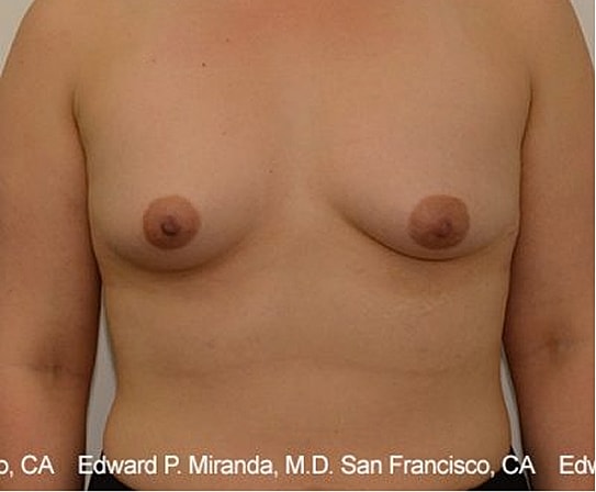 Breast Augmentation Before & After