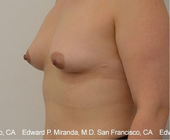 Breast Augmentation Before & After