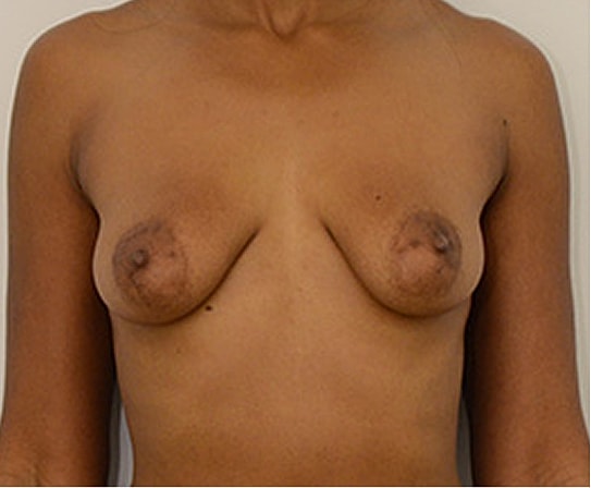 Breast Augmentation Before & After