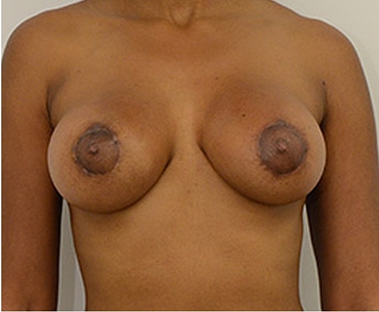 Breast Augmentation Before & After