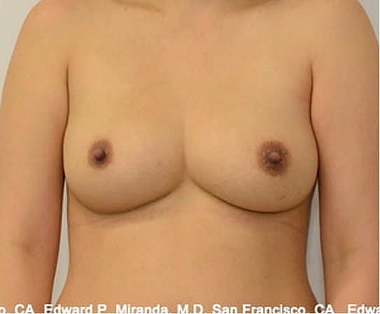 Breast Augmentation Before & After
