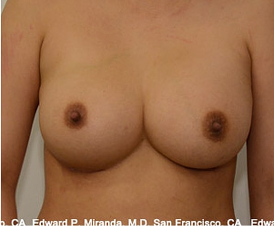 Breast Augmentation Before & After