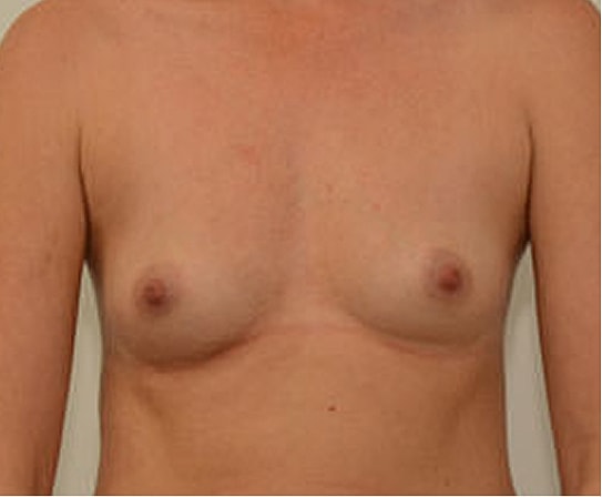 Breast Augmentation Before & After