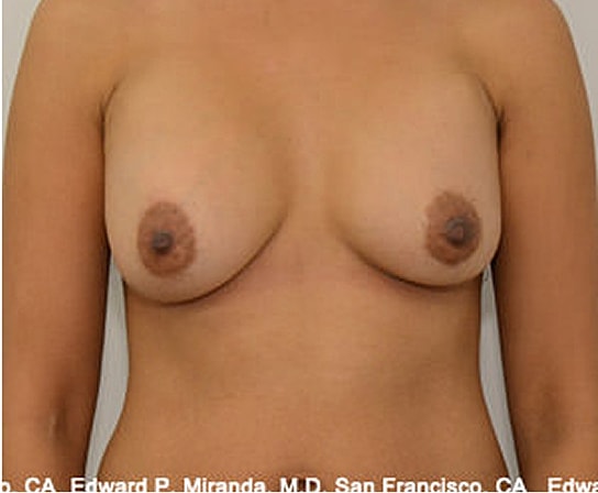 Breast Augmentation Before & After