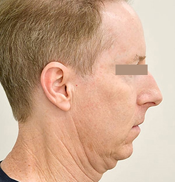Rhinoplasty Before & After