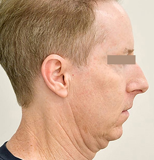 Rhinoplasty Before & After