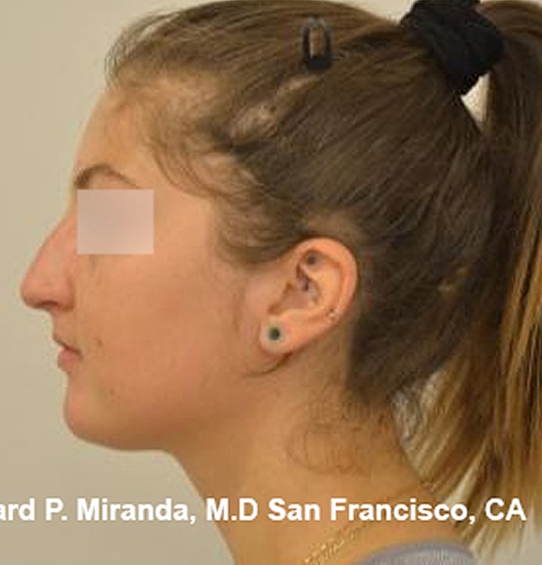 Rhinoplasty Before & After