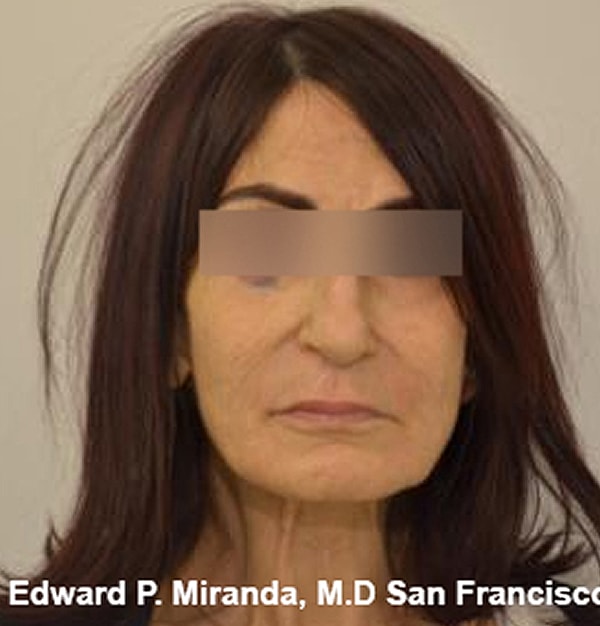 Rhinoplasty Before & After