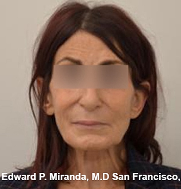 Rhinoplasty Before & After