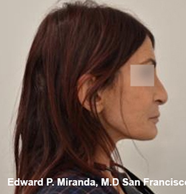 Rhinoplasty Before & After